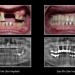 Các phương pháp giảm đau do mọc răng khôn