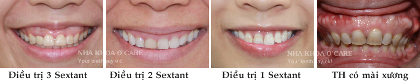 Điều trị cười hở lợi bằng phương pháp phẫu thuật cắt nướu làm dài thân răng