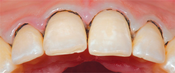 Ngứa lợi răng, nguyên nhân và cách giải quết
