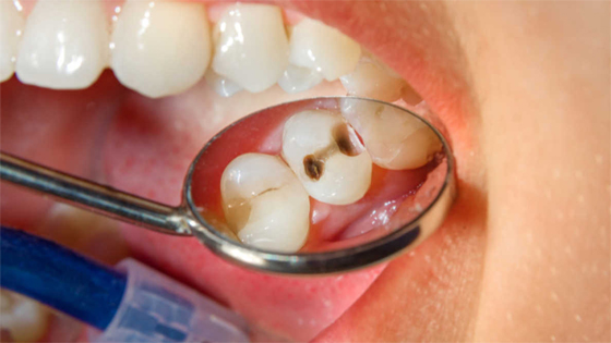 Nguy cơ mất răng vĩnh viễn do các bệnh răng miệng sau đây