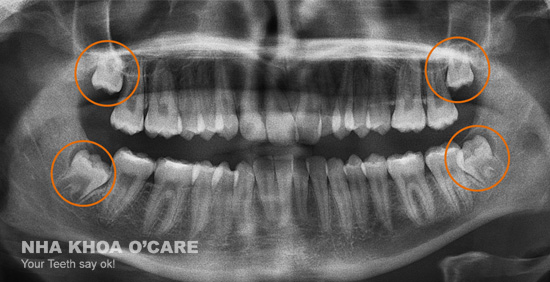 Nhổ răng khôn an toàn, nhanh chóng tại nha khoa O'CARE