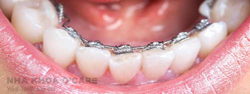 Niềng răng, giải pháp điều chỉnh lại hàm răng lệch lạc, hô móm
