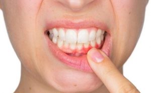 Tẩy trắng răng bằng công nghệ BleachBright