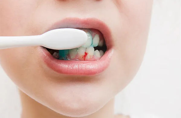 Thường xuyên bị chảy máu chân răng sau khi đánh răng?