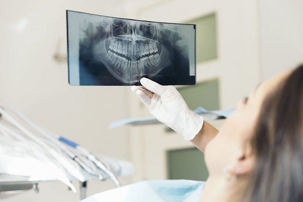 Vì sao phải chụp X – Quang trước khi niềng răng?